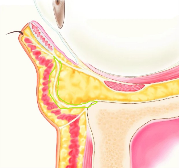 Lower Eyelid Sagging Is Caused by the 'Bone,' Not the Skin (Key Points of Lower Eyelid Fat Repositioning) image 5