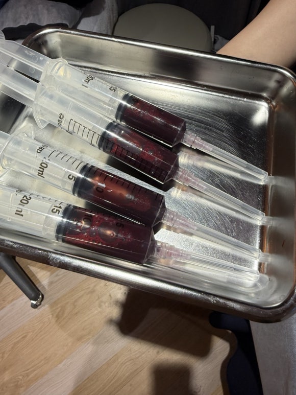 ✨ My Firsthand Review of a Stem Cell Procedure – My Skin, Sleep, and Overall Condition Have Changed image 2