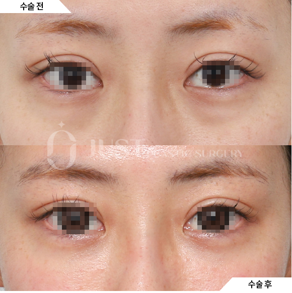 What Is the Most Common Question During a Lower Eyelid Fat Repositioning Consultation? Part 1. What Improvements Does It Make? image 4