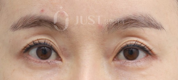 Sunken Upper Eyelids: When Should You Get Fat Grafting? image 1