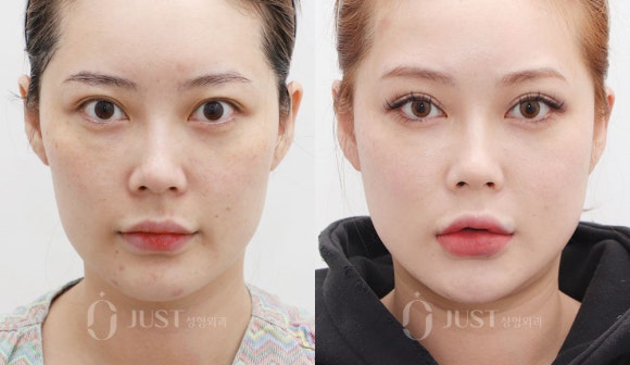 눈꼬리 리프팅, 고양이상이 되고 싶으면 이 글을 보세요! 관련 이미지 8