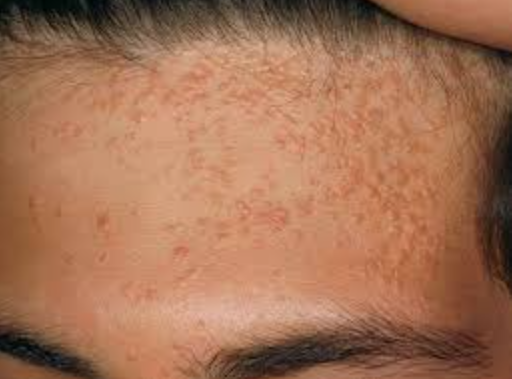 신촌 편평사마귀, 셀프 진단법 알려드립니다 관련 이미지 3