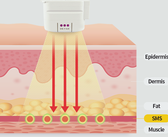 홍대 울쎄라, 관련 이미지 5