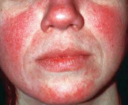 연남동 피부과, 주사(Rosacea)를 알고 계시나요? 관련 이미지 3