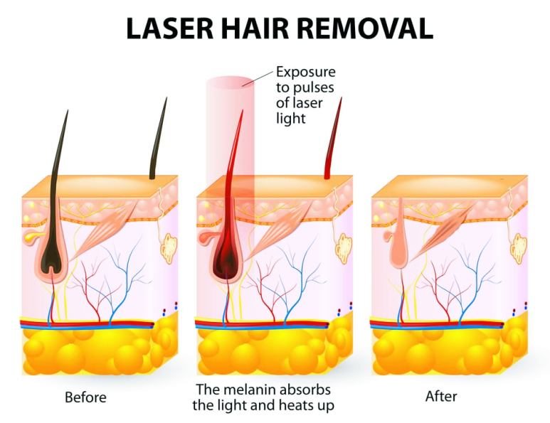 홍대 레이저 제모, 효과가 없었다면 필독하세요 관련 이미지 4