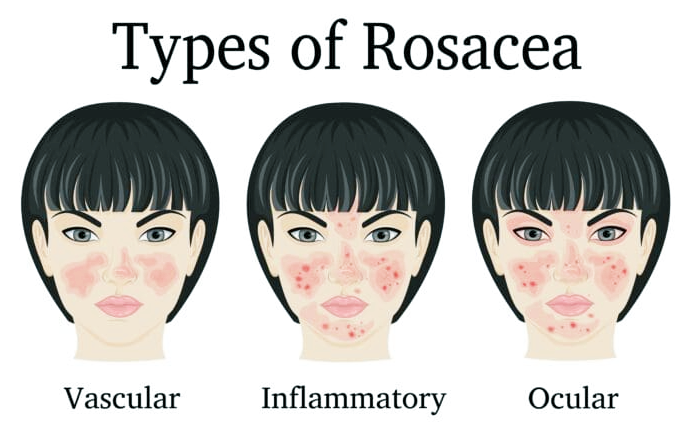 연남동 피부과, 주사(Rosacea)를 알고 계시나요? 관련 이미지 2