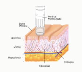 홍대 리쥬란, 정말 피부가 재생되나요? 관련 이미지 8