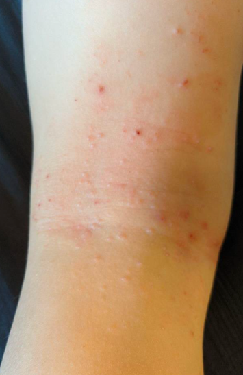 신촌 편평사마귀, 셀프 진단법 알려드립니다 관련 이미지 4