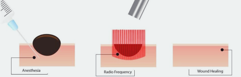 서울 점 잘빼는곳, 제거 후 다시 생기는 이유? 관련 이미지 4