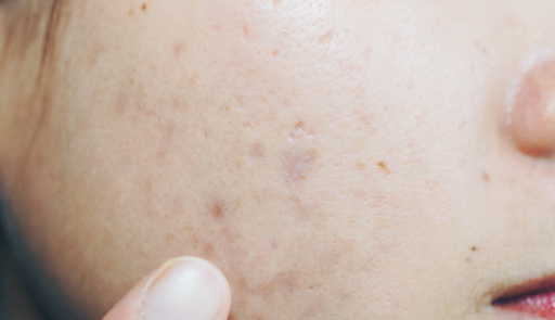 홍대 여드름 피부과? 단계마다 달라지는 치료 관련 이미지 5