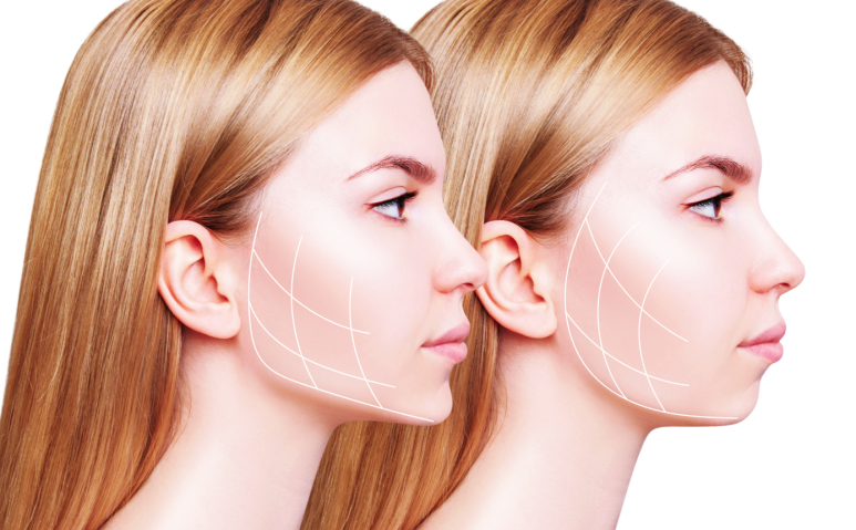 홍대 보톡스, 사각 턱으로 고민이신 분들께 관련 이미지 3