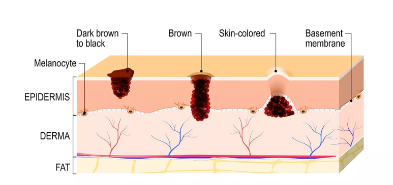 홍대 점빼기, 관련 이미지 4