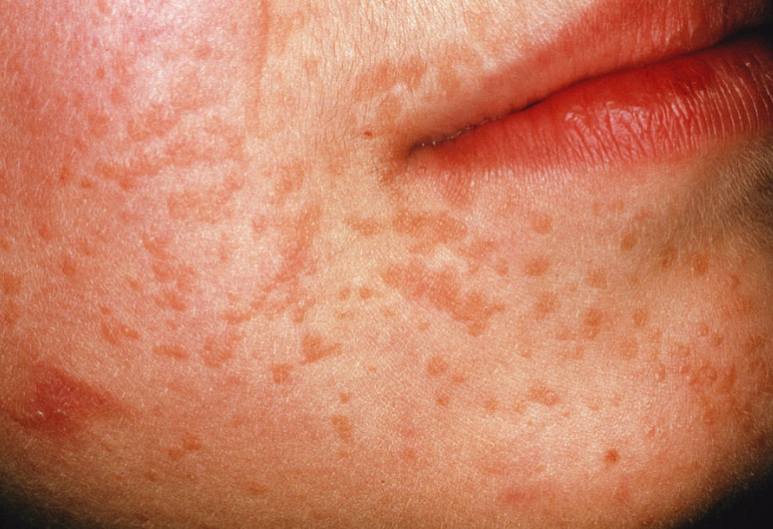 홍대 편평사마귀, 헷갈리면 큰일 납니다. 관련 이미지 5