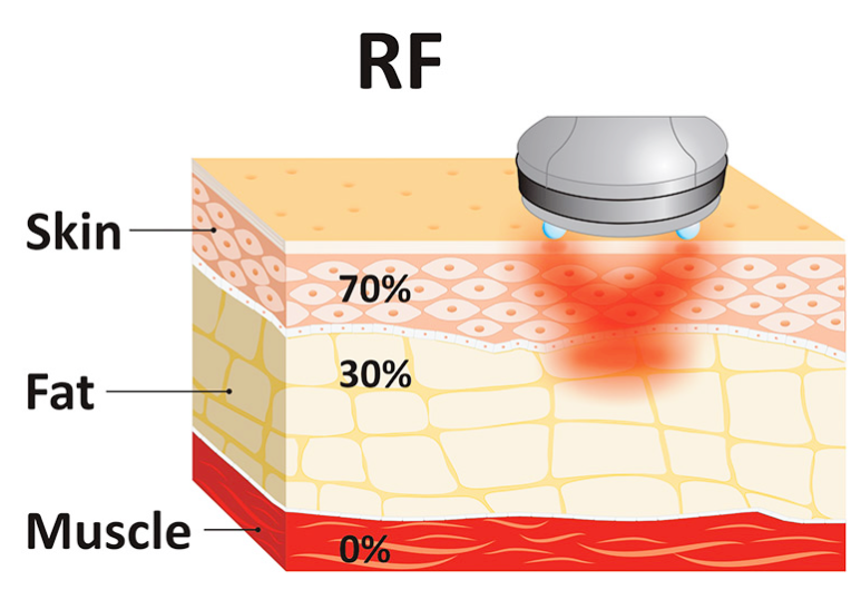 홍대 온다리프팅, 언제 그리고 왜 필요할까? 관련 이미지 4