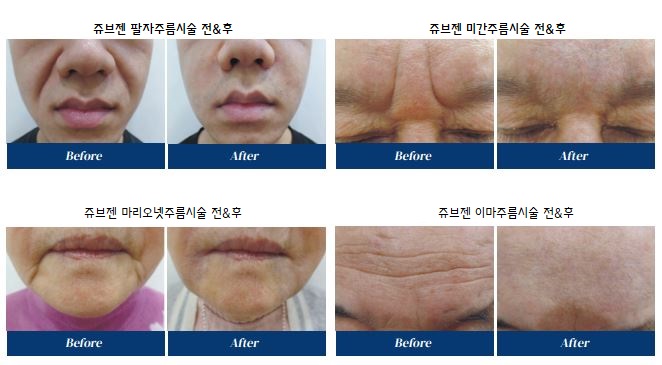 세가지소원의원홍대피부과 10년 유지 🏆쥬브젠 자가진피재생술🏆 런칭이벤트 관련 이미지 15
