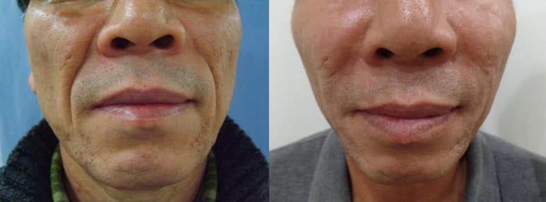 세가지소원의원홍대피부과 10년 유지 🏆쥬브젠 자가진피재생술🏆 런칭이벤트 관련 이미지 11