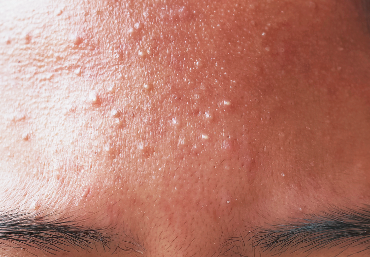 홍대 여드름 피부과? 단계마다 달라지는 치료 관련 이미지 2