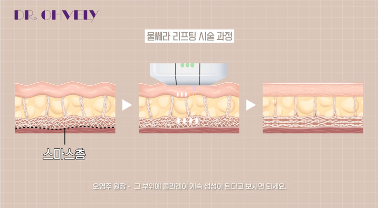 서울 울쎄라, 자주 묻는 질문 BEST 3는? 관련 이미지 3