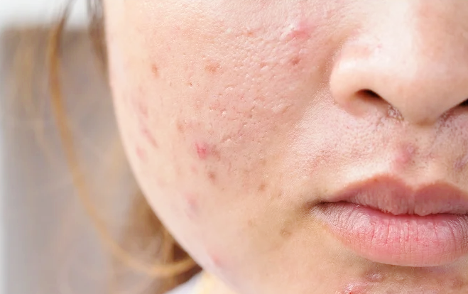 연남동 피부과, 여드름이 고민이시라면 필독 관련 이미지 3