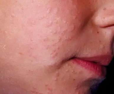 홍대 편평사마귀, 헷갈리면 큰일 납니다. 관련 이미지 3