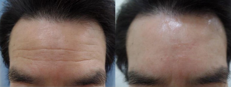 세가지소원의원홍대피부과 10년 유지 🏆쥬브젠 자가진피재생술🏆 런칭이벤트 관련 이미지 14