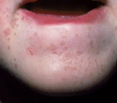 홍대 편평사마귀, 헷갈리면 큰일 납니다. 관련 이미지 4