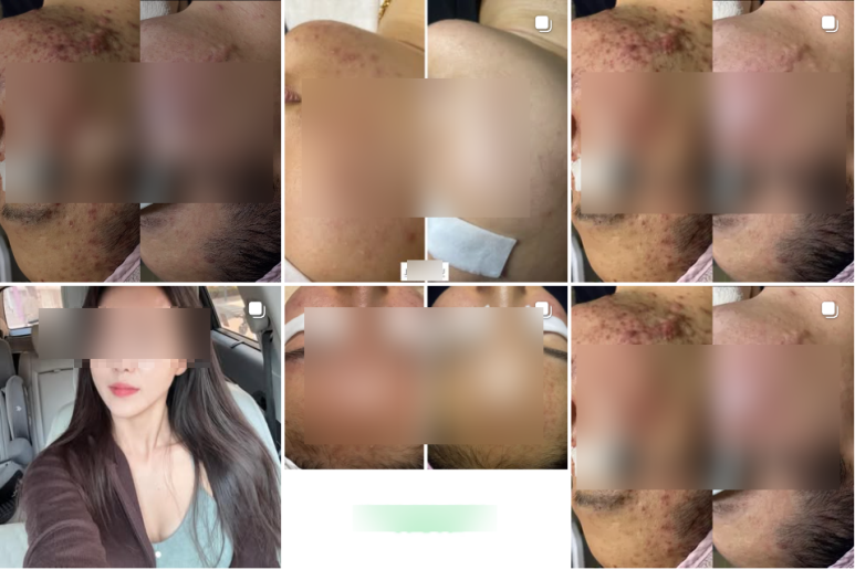 신촌역 피부과, 시술은 했는데 왜 티가 안 날까요? 관련 이미지 3