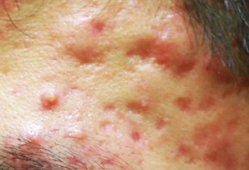 홍대 여드름 피부과? 단계마다 달라지는 치료 관련 이미지 3