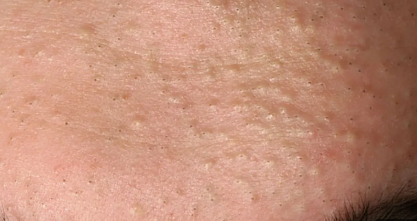 홍대 편평사마귀, 헷갈리면 큰일 납니다. 관련 이미지 2