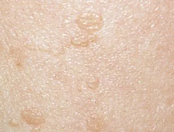 신촌 편평사마귀, 셀프 진단법 알려드립니다 관련 이미지 6