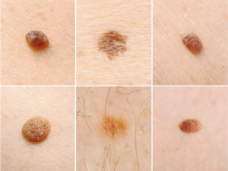 홍대 점빼기, 관련 이미지 3