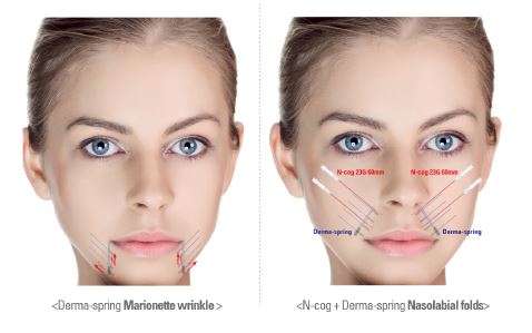 [잠실 연세힐피부과]더마스프링(Dermaspring), 용수철 같은 탄성을 지닌 녹슨 실 관련 이미지 3