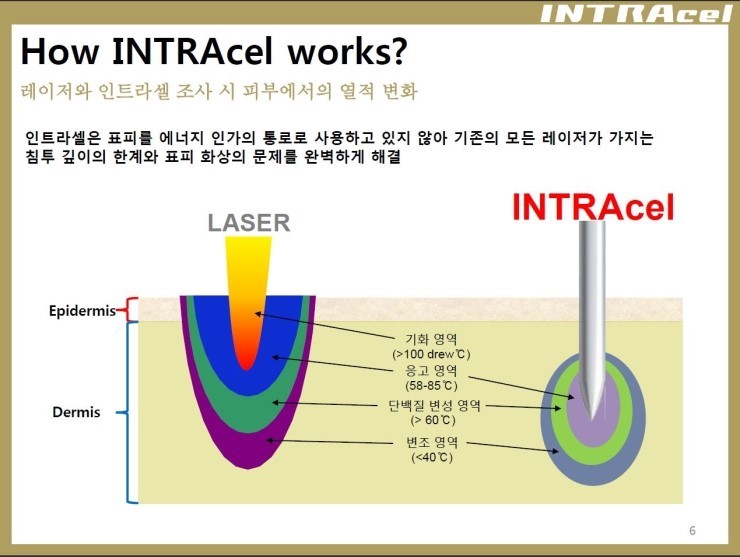 [잠실 연세힐피부과]여드름흉터 및 모공 치료의 새로운 강자 "인트라셀" 관련 이미지 2