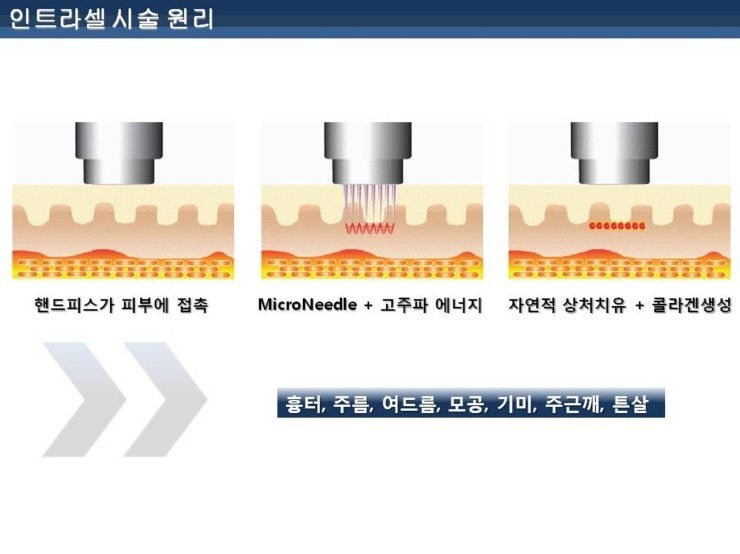 [잠실 연세힐피부과]여드름흉터 및 모공 치료의 새로운 강자 "인트라셀" 관련 이미지 1