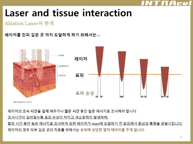 [잠실 연세힐피부과]여드름흉터 및 모공 치료의 새로운 강자 "인트라셀" 관련 이미지 3