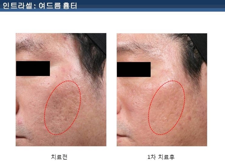 [잠실 연세힐피부과]여드름흉터 및 모공 치료의 새로운 강자 "인트라셀" 관련 이미지 5