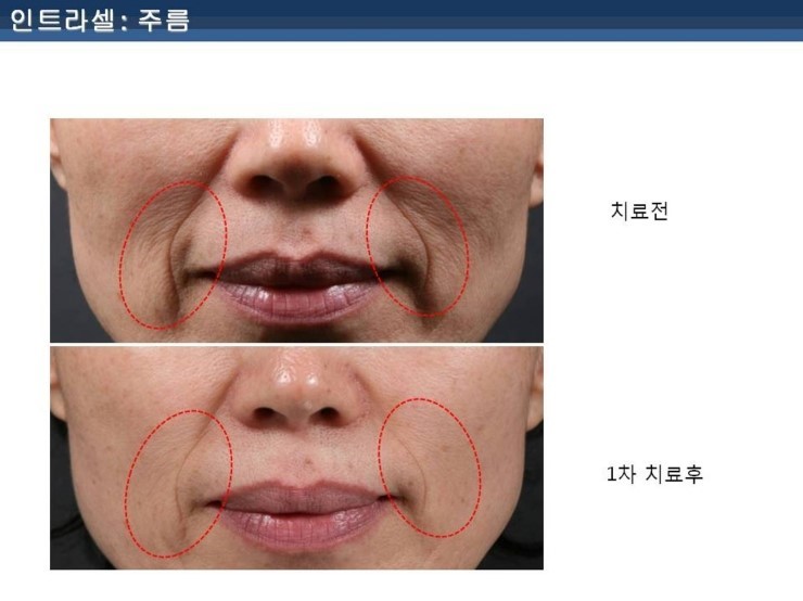 [잠실 연세힐피부과]여드름흉터 및 모공 치료의 새로운 강자 "인트라셀" 관련 이미지 11