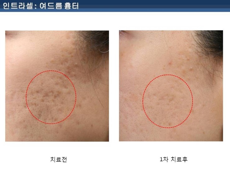 [잠실 연세힐피부과]여드름흉터 및 모공 치료의 새로운 강자 "인트라셀" 관련 이미지 7