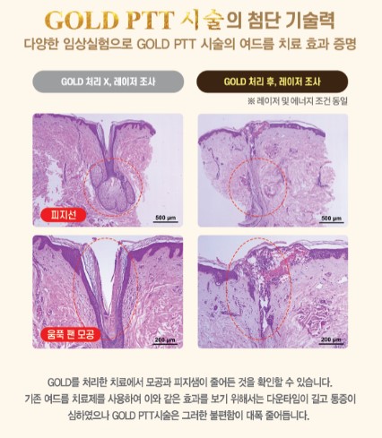 [잠실 연세힐피부과] 골드 PTT : 골드와 레이저 빛을 이용한 여드름 치료의 신기원 관련 이미지 4