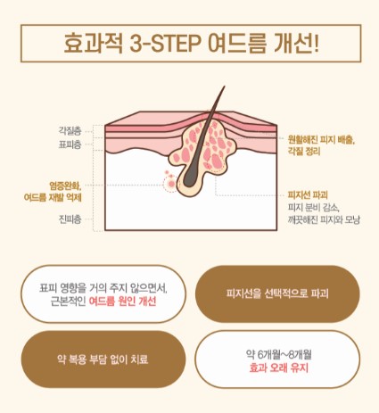 [잠실 연세힐피부과] 골드 PTT : 골드와 레이저 빛을 이용한 여드름 치료의 신기원 관련 이미지 3