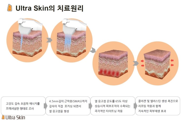 [잠실 연세힐피부과]신개념 초음파 리프팅 관련 이미지 2