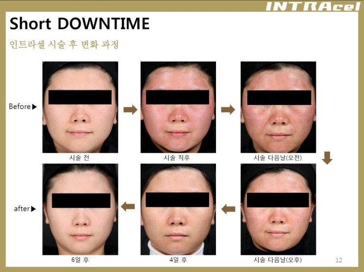 [잠실 연세힐피부과]여드름흉터 및 모공 치료의 새로운 강자 "인트라셀" 관련 이미지 4
