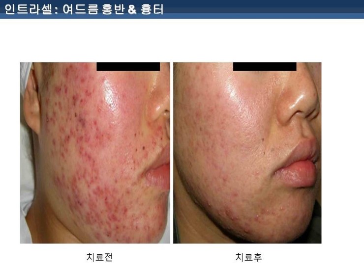[잠실 연세힐피부과]여드름흉터 및 모공 치료의 새로운 강자 "인트라셀" 관련 이미지 9