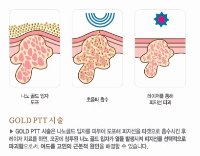 [잠실 연세힐피부과] 골드 PTT : 골드와 레이저 빛을 이용한 여드름 치료의 신기원 관련 이미지 2