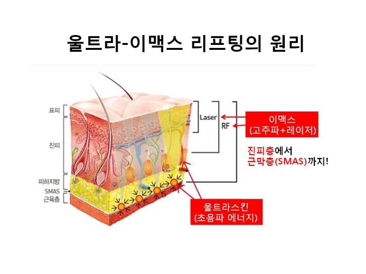 [잠실 연세힐피부과]신개념 초음파 리프팅 관련 이미지 4