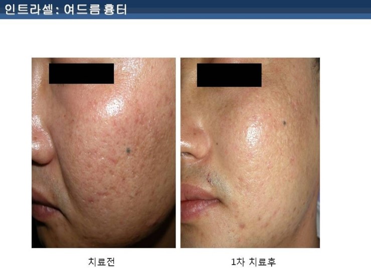 [잠실 연세힐피부과]여드름흉터 및 모공 치료의 새로운 강자 "인트라셀" 관련 이미지 8