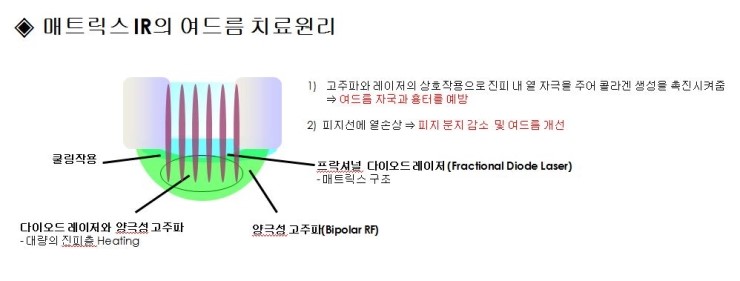 [잠실 연세힐피부과] 빛과 고주파를 이용한 여드름 치료 관련 이미지 2