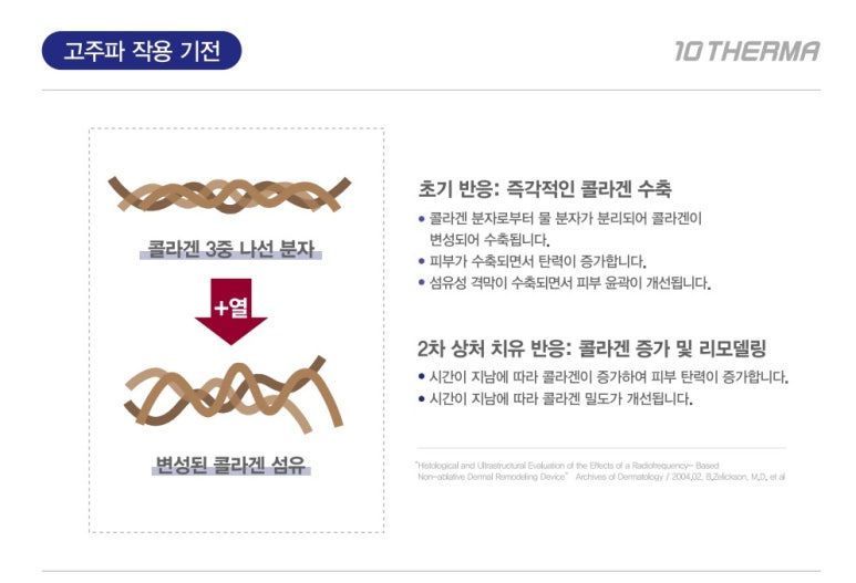 [잠실 연세힐피부과] 고주파 리프팅의 새로운 기준 : 텐써마 - 통증은 줄이고, 효과는 Up!!! 관련 이미지 4