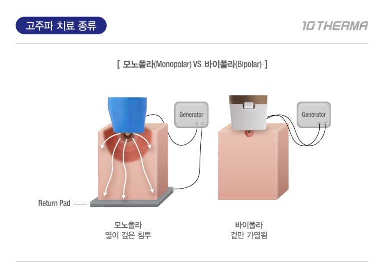 [잠실 연세힐피부과] 고주파 리프팅의 새로운 기준 : 텐써마 - 통증은 줄이고, 효과는 Up!!! 관련 이미지 3