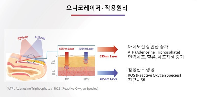 [잠실 연세힐피부과] 오니코레이저(실손보험 적용가능 손발톱 무좀 치료 레이저) 도입 관련 이미지 5
